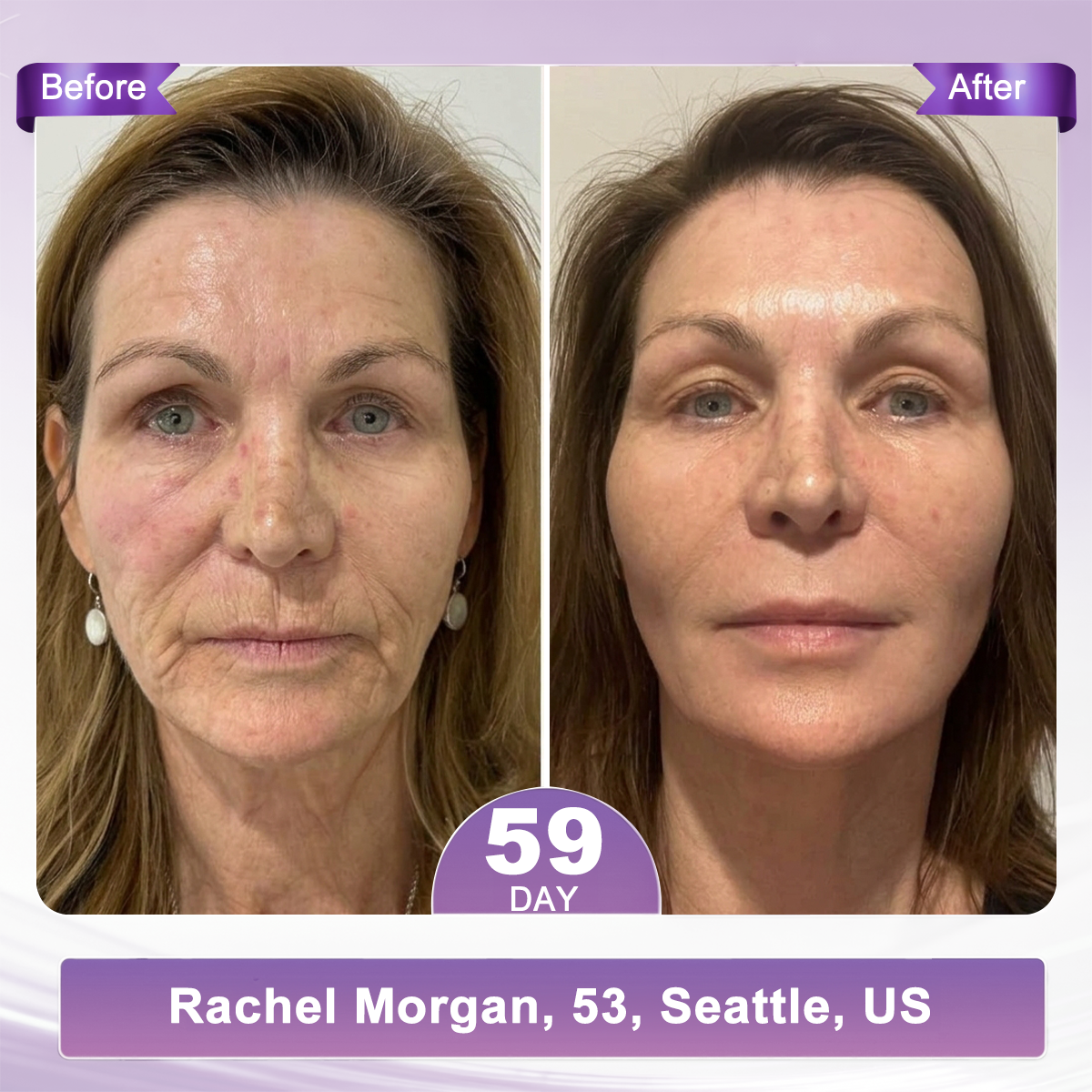 Official: 𝐇𝐈𝐒𝐊𝐈𝐍® 𝐏𝐃𝐑𝐍 𝐌𝐮𝐥𝐭𝐢-𝐏𝐞𝐩𝐭𝐢𝐝𝐞 𝐌𝐚𝐬𝐬𝐚𝐠𝐢𝐧𝐠 𝐁𝐨𝐝𝐲 𝐑𝐨𝐥𝐥𝐞𝐫 𝐂𝐫𝐞𝐚𝐦- Anti-aging, Hydrating, Skin Firming & Lifting, Skin Repair, Even Tone, Acne and Dark Spot Treatment, Wart and Mole Removal, and Psoriasis Relief.
