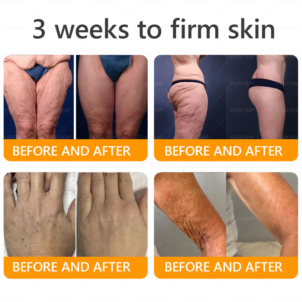 🇬🇧✨Made and Shipped from UK ✨ PUROSA® Bee Venom Wrinkle-Firming Multi-purpose Cream 🔥 LAST DAY 80% OFF